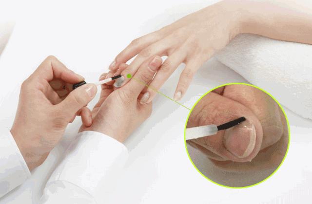 十年灰指甲可以治好吗,一次搞定顽固灰指甲