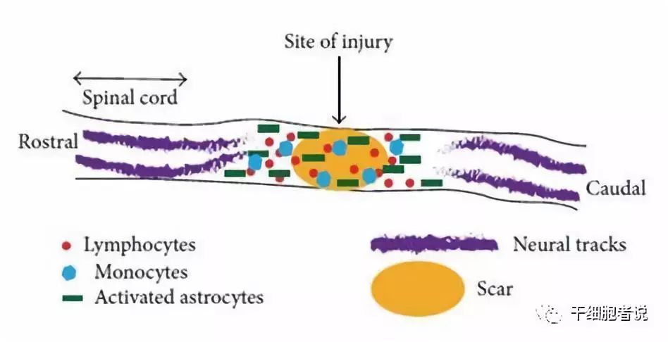 日本干细胞治疗脑卒中病人,日本干细胞治疗脊髓损伤的进展