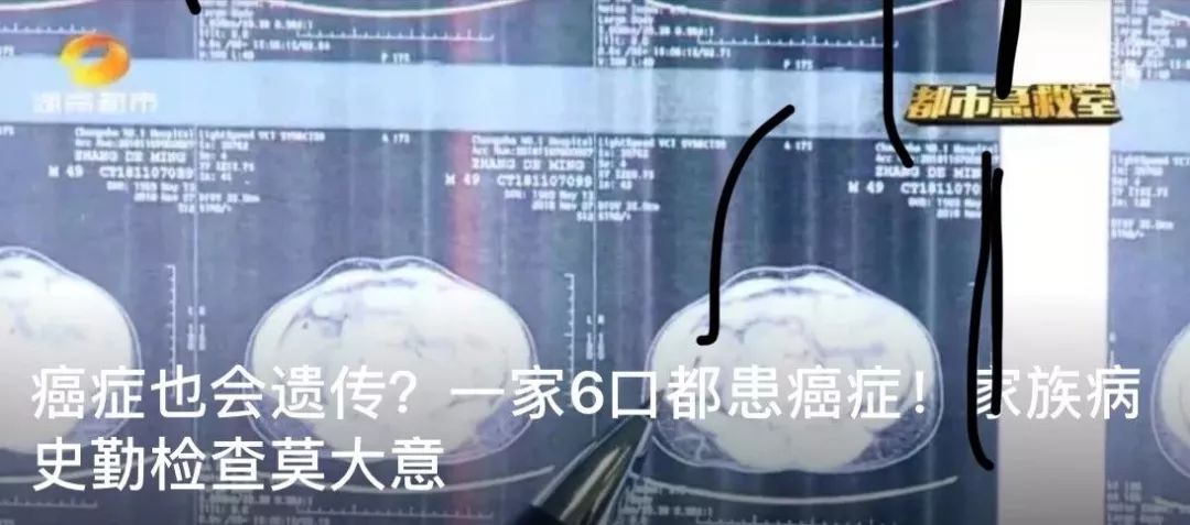 踢球猝死的案例,足球队员心源性猝死