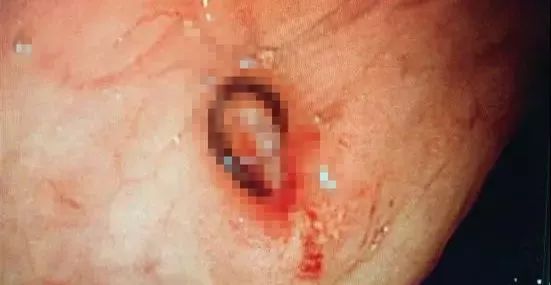 女子反复便血后续,28岁女性反复便血一年多