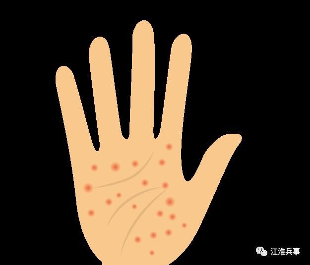 冬天小腿皮肤瘙痒湿疹,冬天湿疹瘙痒中医怎么治