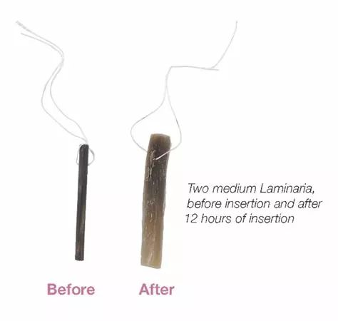 宫腔镜剔除子宫肌瘤大概多少钱,子宫摘除后的科普