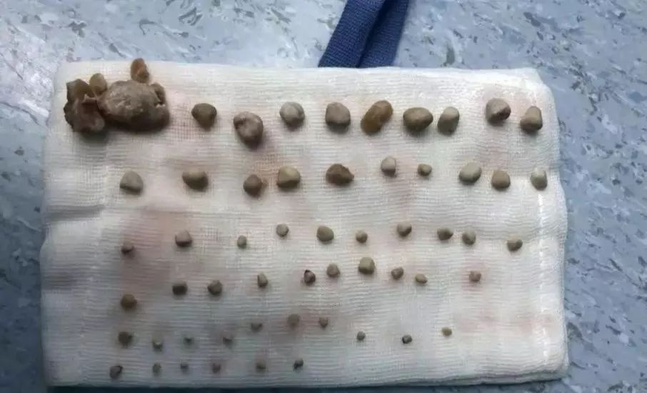 9岁娃肾里塞满56个结石,九岁孩子体内取出56颗结石