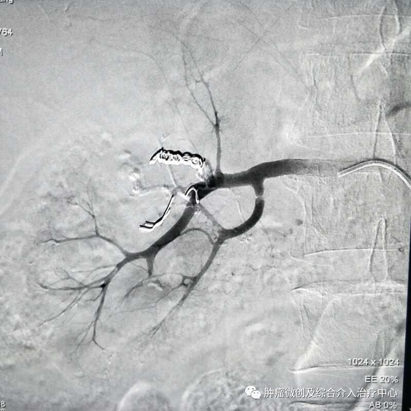 运城市第一医院肿瘤科咋样,运城第一医院治疗肿瘤怎么样