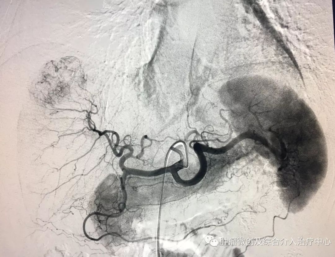 运城市第一医院肿瘤科咋样,运城第一医院治疗肿瘤怎么样