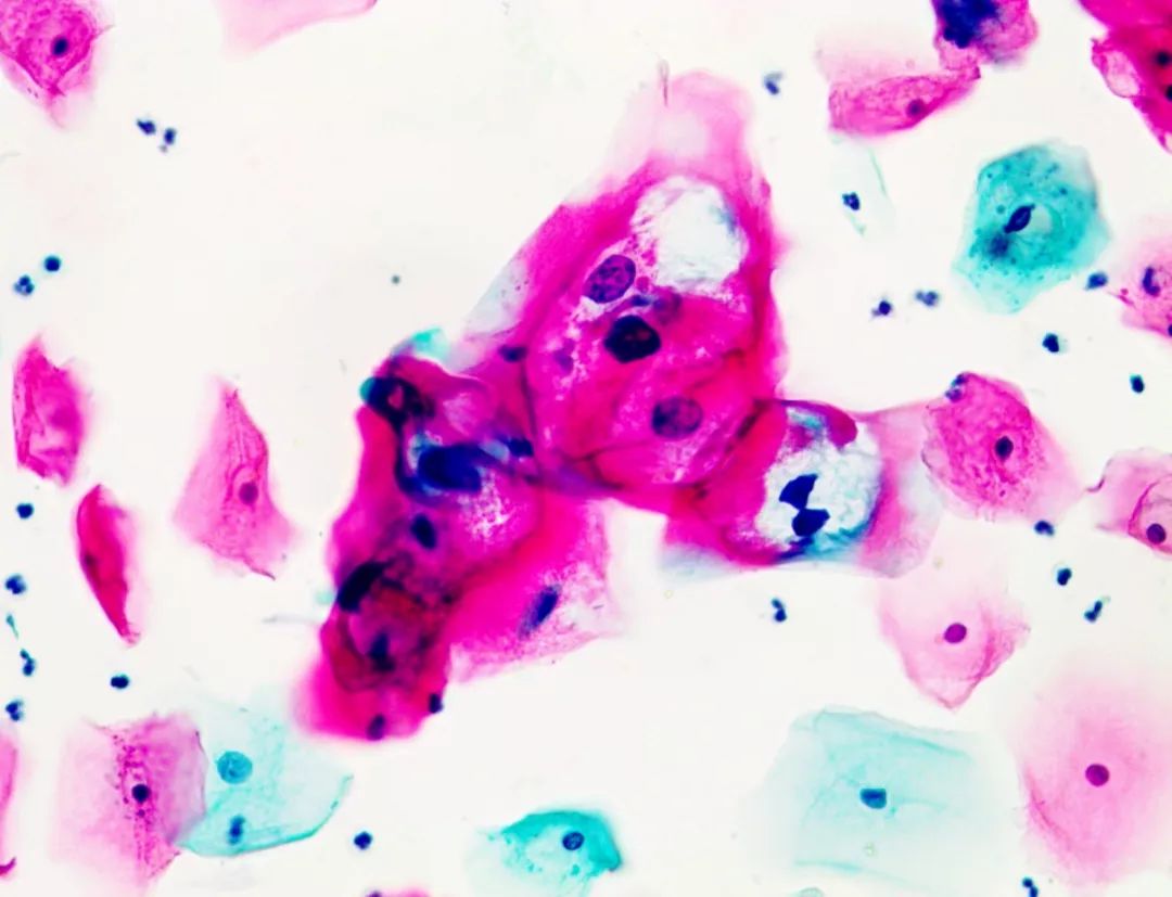 宫颈癌筛查tct和hpv能查出什么,宫颈癌筛查到底查tct还是hpv