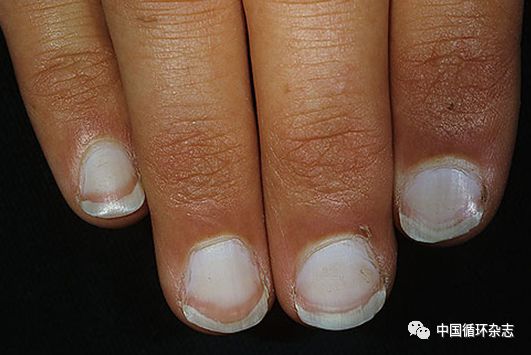 指甲代表肝功能吗,指甲病是肝不好吗