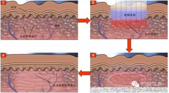 激光美容技术有用吗,解读激光美容的六大疑惑