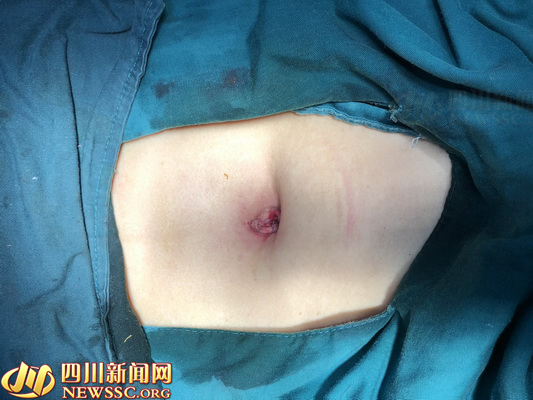 提升患者美学感受宜宾市医学会妇产科分会举行单孔腹腔镜沙龙