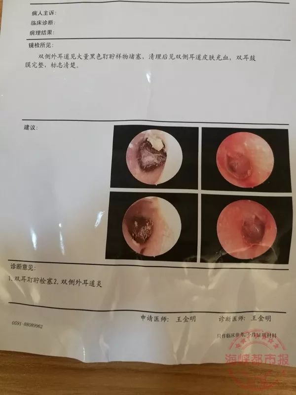 男子掏耳朵花掉几千块,去医院掏耳朵花了两百多