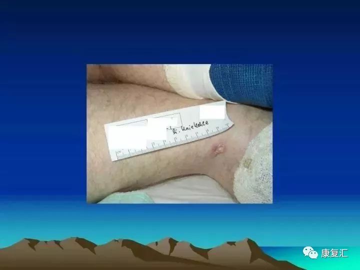 痉挛症可以治疗好吗,痉挛的康复