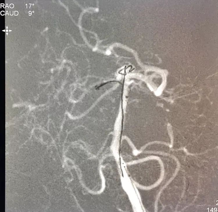 柳暗花明专栏|栓塞颅内动脉瘤时微导管无法穿过LVIS支架网眼怎么办