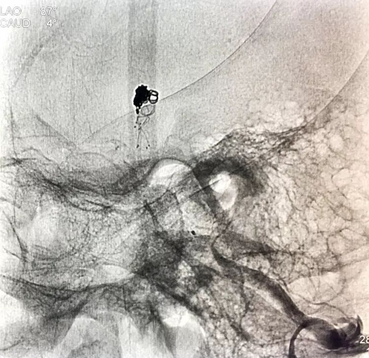 柳暗花明专栏|栓塞颅内动脉瘤时微导管无法穿过LVIS支架网眼怎么办