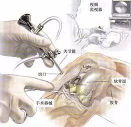 半月板损伤康复后能和之前一样么,三度半月板损伤手术几天出院
