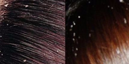 头皮屑洗不掉怎么办有什么方法,头发头皮屑多且大块还结痂有虫