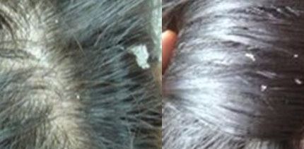 头上头皮屑和剪发虫怎么解决,头皮屑多和肚子里有虫有关系吗