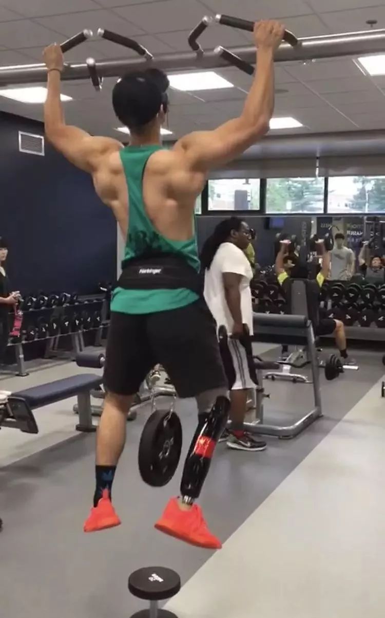 俄罗斯留学生骨折截肢,留学生意外被截肢