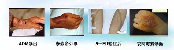 picc静脉置管维护挂哪个科好,picc置管后有什么注意事项