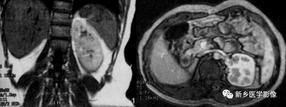 肾脏形态变异怎么办,肾脏疾病鉴别五项意义