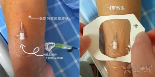 针拔出来血管就可以愈合吗,拔针把血管戳破了咋办