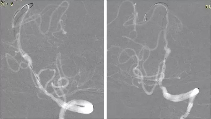 椎动脉v4段血管瘤介入治疗,臭氧治疗左侧v4段椎动脉狭窄