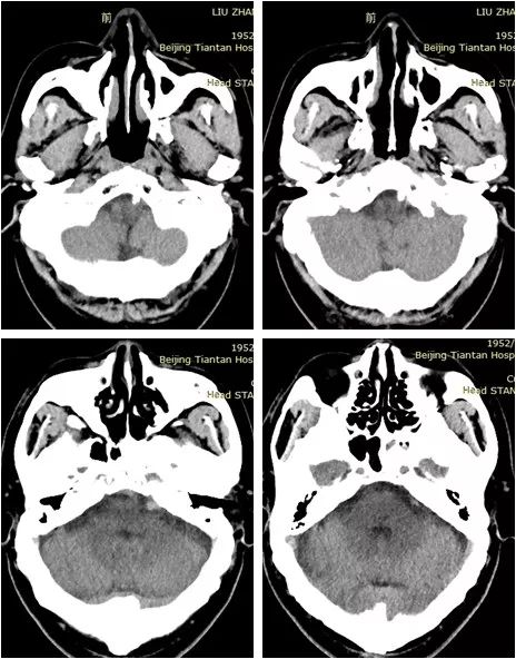 椎动脉v4段血管瘤介入治疗,臭氧治疗左侧v4段椎动脉狭窄