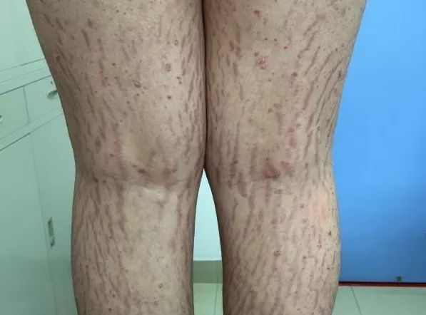 孩子身上长了一片褐色有毛斑点,小孩身上长褐色斑还有毛