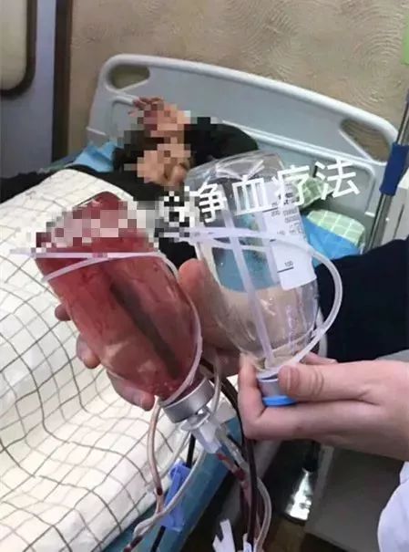 减肥出大事！23岁姑娘紧急“换肝”捡回一条命！