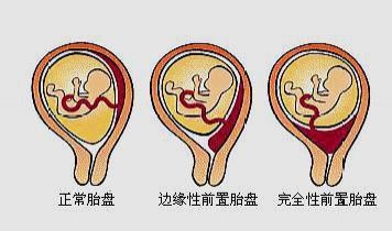 孕妇胎盘位置异常怎么办,胎盘异常导致胎停