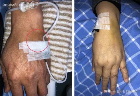 扎留置针有回血送针失败,留置针回血穿刺失败