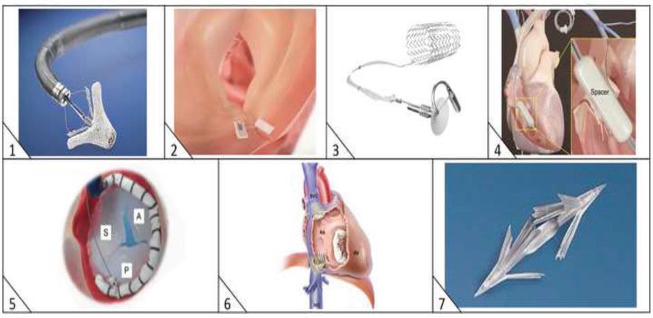 经导管瓣膜修复术费用,经导管瓣膜植入术风险