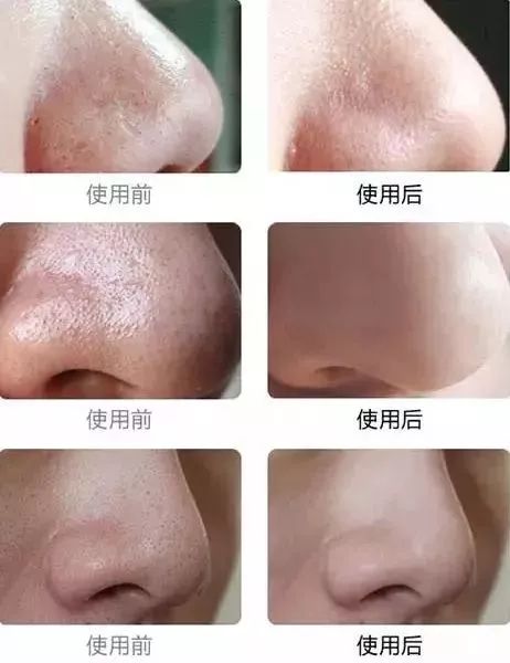 辣眼睛，有人用它吸出一整年的黑头，看完我果断下单了！