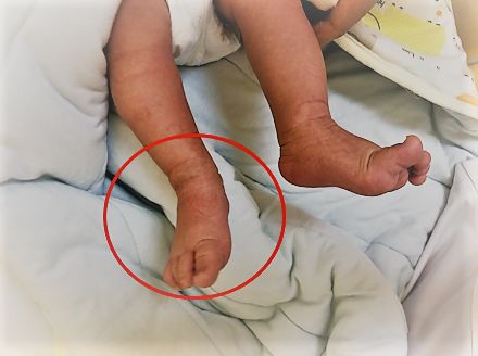 刚出生就要打石膏?硬核医生手工打造矫形器治疗足外翻