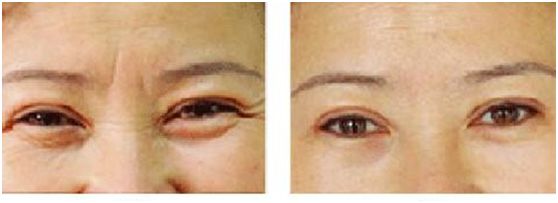 外用涂抹式肉毒素可以祛皱纹吗,去皱纹的肉毒素一年打几次为佳