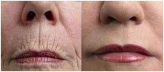 外用涂抹式肉毒素可以祛皱纹吗,去皱纹的肉毒素一年打几次为佳