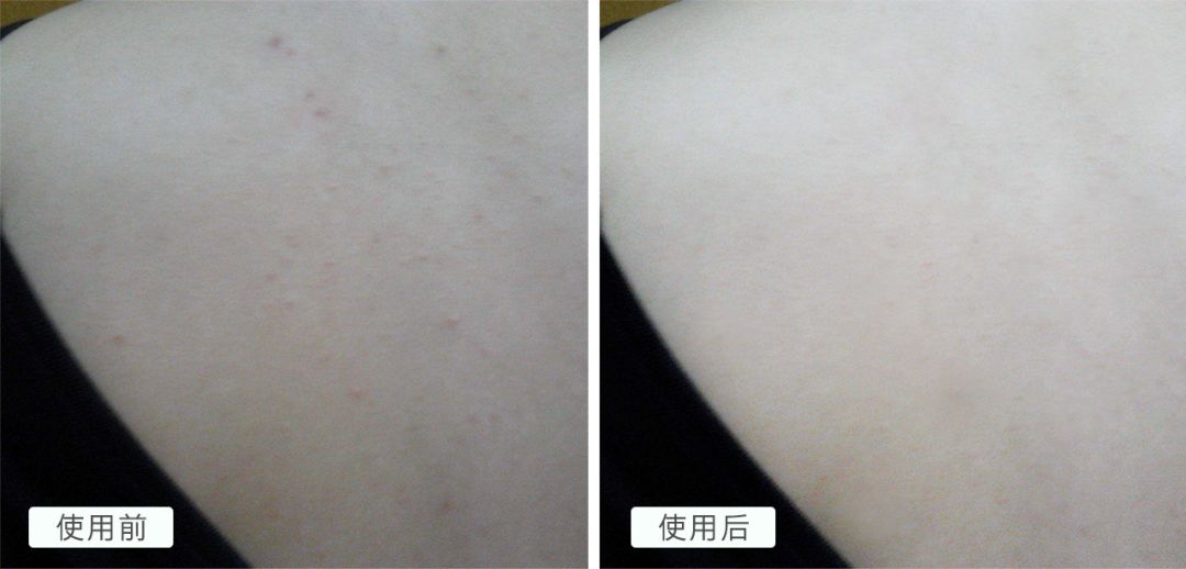20分钟清理背部螨虫痘痘,十秒去除螨虫