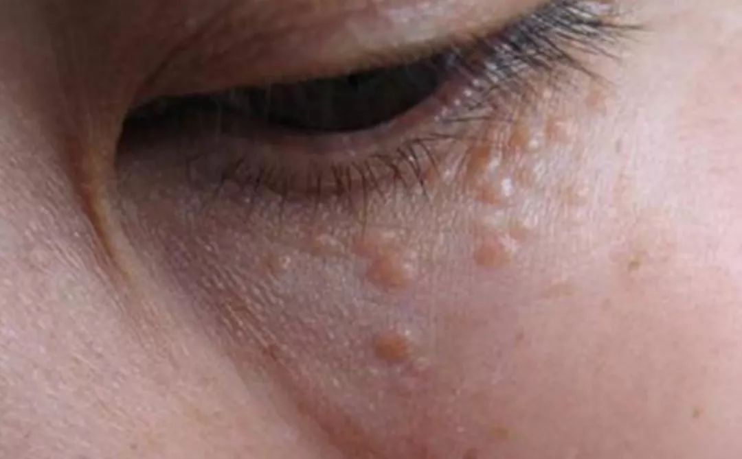 涂眼霜会导致脂肪粒？No