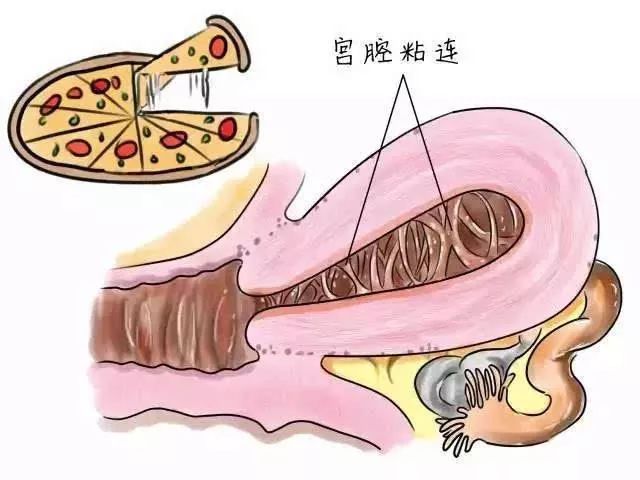 宫腔粘连是什么意思,宫腔粘连可以治好吗