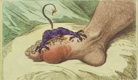 为什么太监不会得痛风,太监会患痛风吗