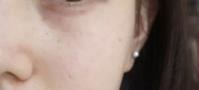 晒斑痘印去除土方法,5个祛斑小妙招淡化晒斑雀斑痘印