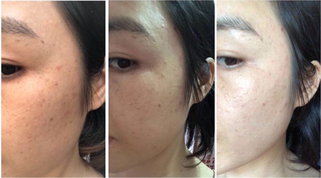 严重痘印晒斑,5个祛斑小妙招淡化晒斑雀斑痘印