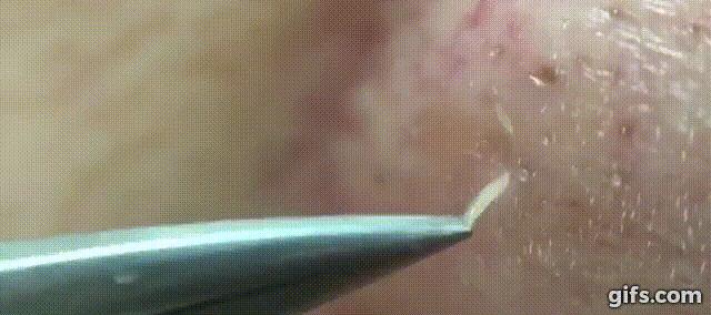 鼻头痘痘爆浆,鼻头痘痘挤出来的白色物质是什么