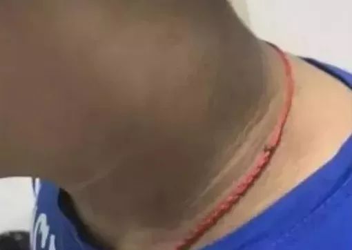 孩子脖子很黑洗不掉是怎么回事,孩子脖子黑洗不下去