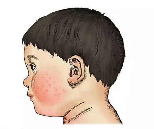 宝宝得了湿疹皮炎怎么办,婴儿特殊类型的湿疹以及皮炎