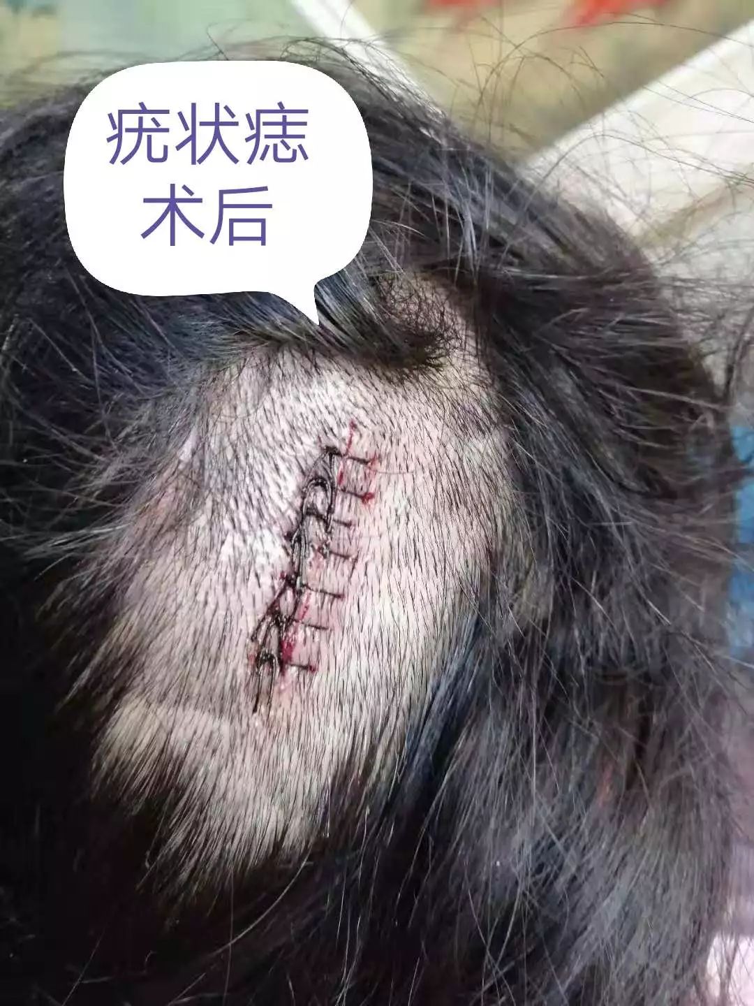 小小黑痣该不该治？该如何治？