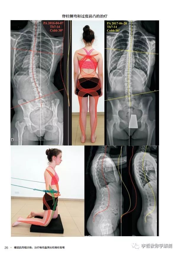 腰间盘突出脊柱侧弯康复训练,螺旋肌肉链训练治疗腰椎间盘突出