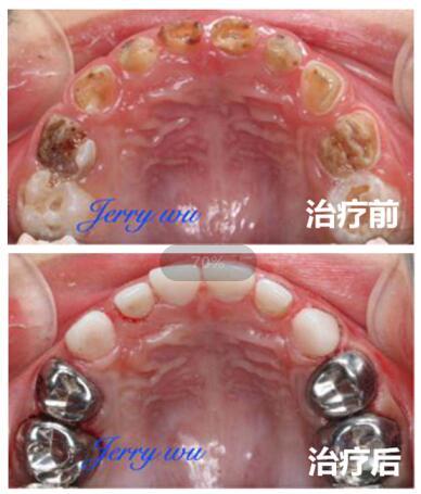 儿童一口牙全坏了但不痛,三岁半宝宝满口蛀牙怎么挽救