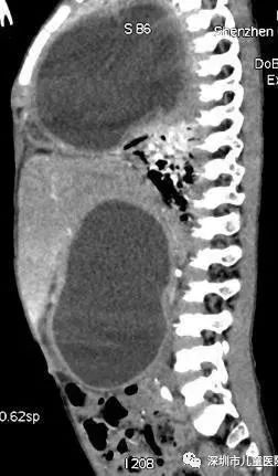 4岁娃肚大如孕妇，竟从体内抽出2斤寄生虫液！