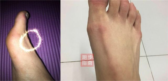 跑步脚中间凹处疼是怎么回事,跑步脚上的筋痛怎么回事