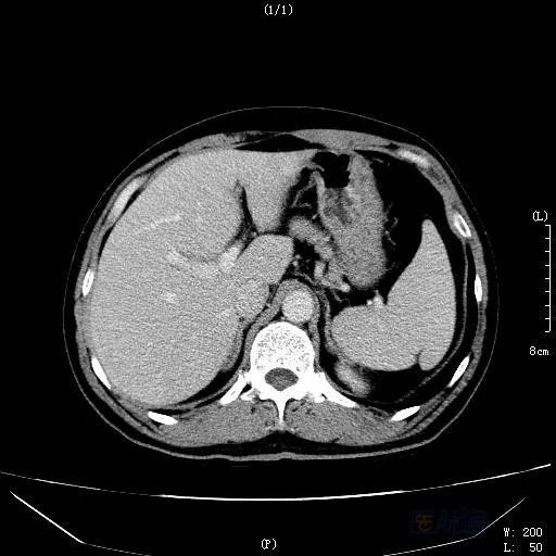 身边有肝癌治好的吗,治好肝癌全国首例